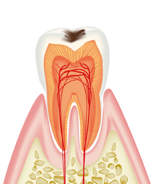 C1（エナメル質の虫歯）