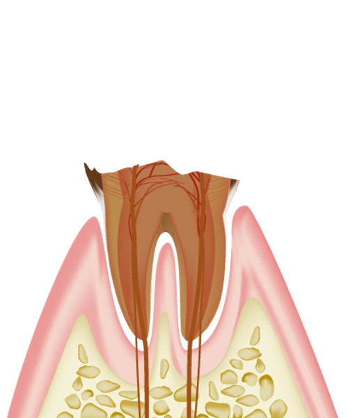 C4（末期の虫歯）