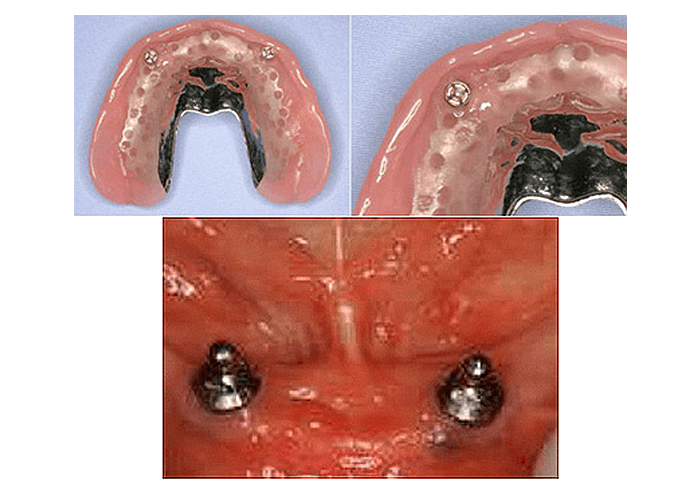 ボールアタッチメント