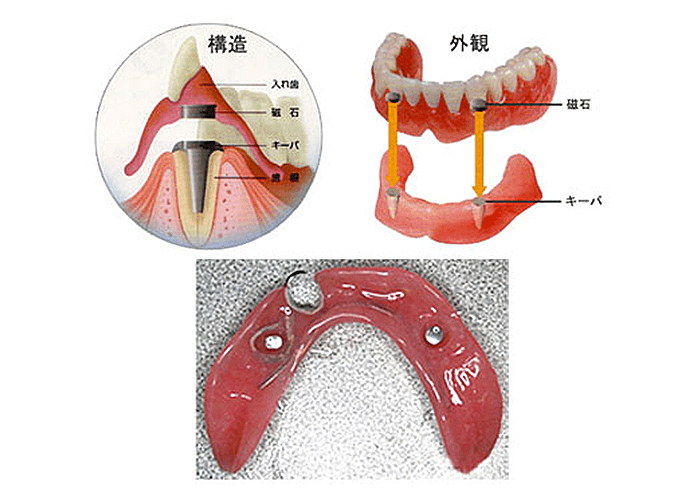 磁性アタッチメント（マグネット）