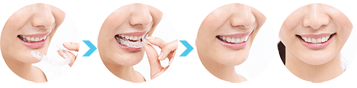 インビザライン