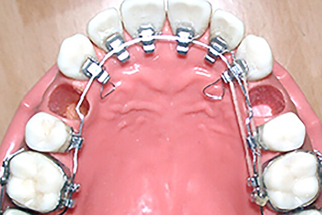 舌側（内側）矯正