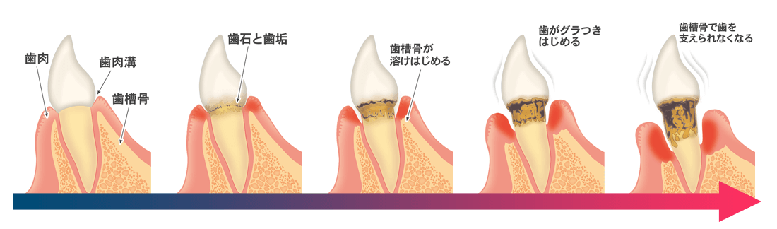歯周病の進行