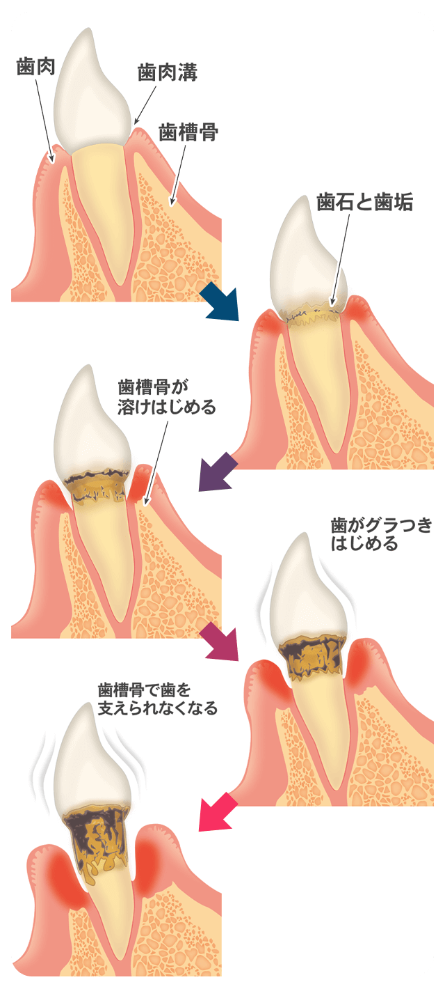 歯周病の進行