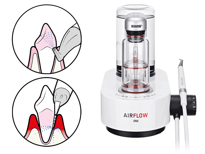 エアーフローによる歯のクリーニング