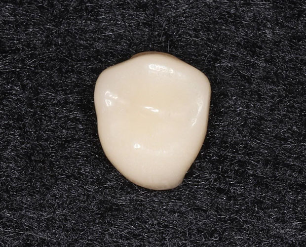 CAD/CAM冠（保険診療）