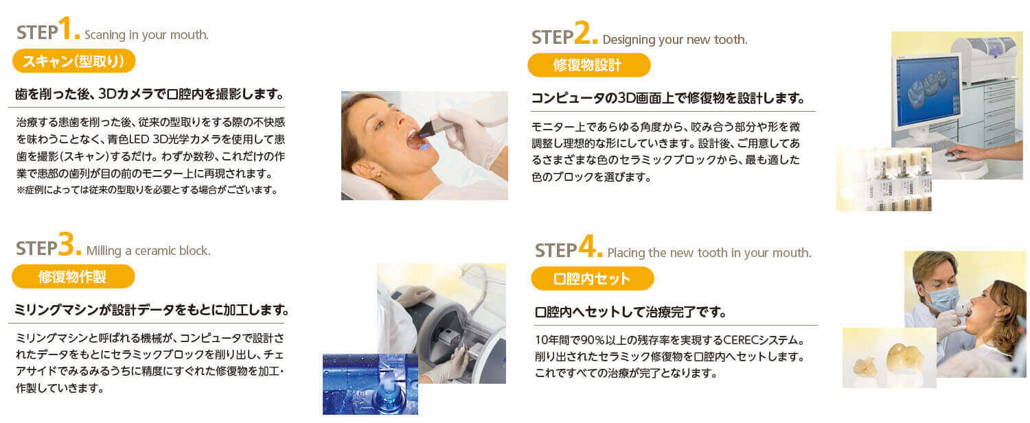 セレック治療の流れ