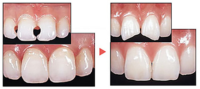 ダイレクトボンディング（保険適応外ハイブリッドセラミックを使用）