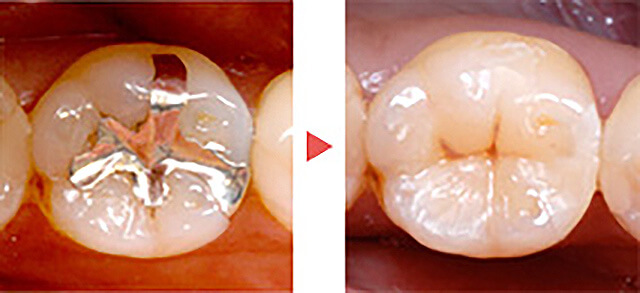 ダイレクトボンディング