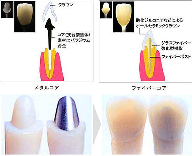 ファイバーコアとメタルコア