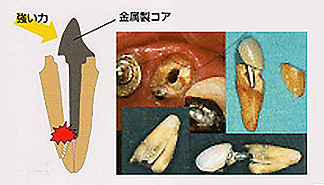 メタルコアの破損