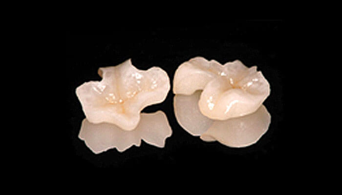 インレー（詰め物）