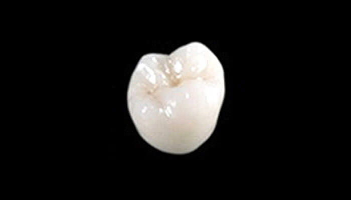 クラウン（被せ物）