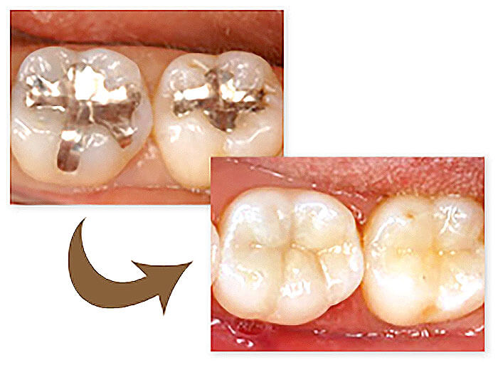 セラミック治療