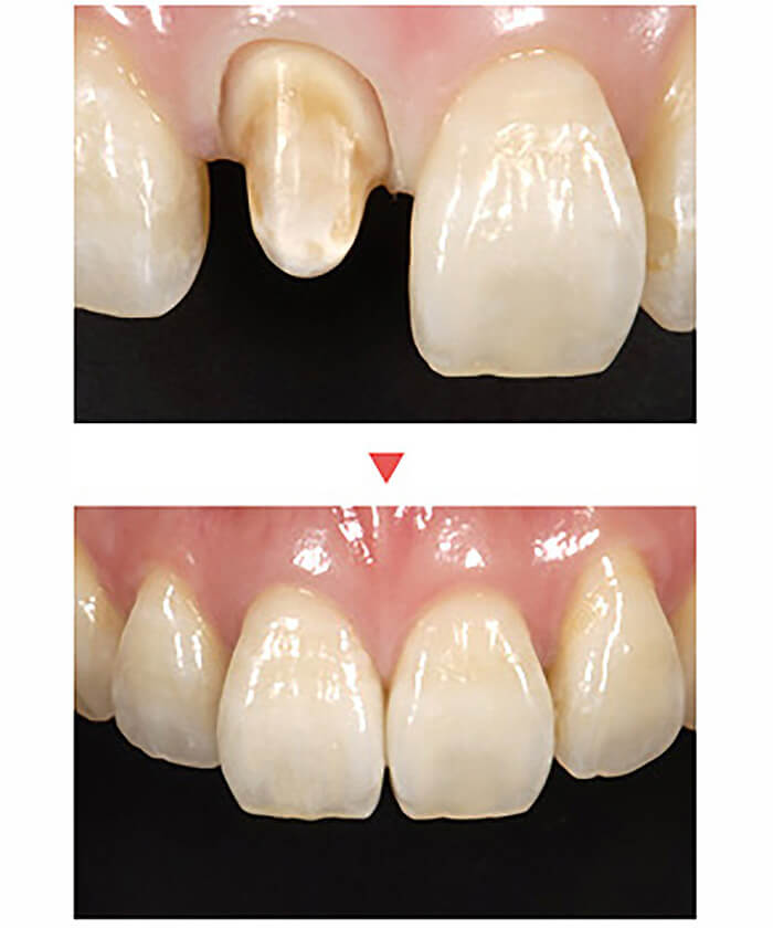 ジルコニアオールセラミック