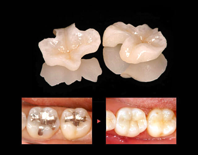 e.max セラミックインレー