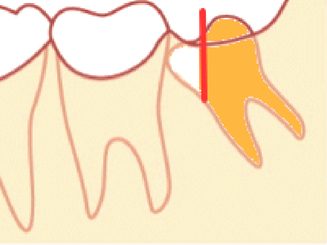 歯の周りの骨を僅かに削ります