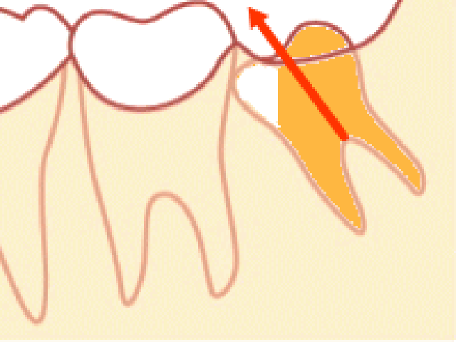 歯の周りの骨を僅かに削ります