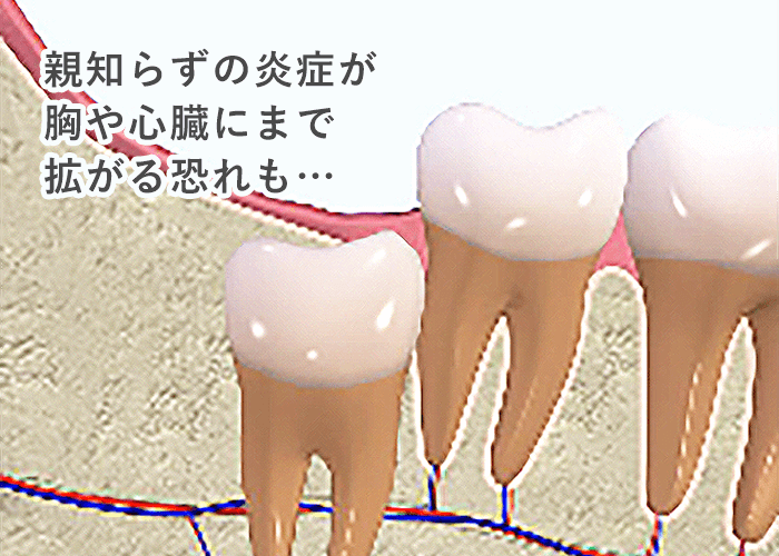 歯の周りの骨を僅かに削ります