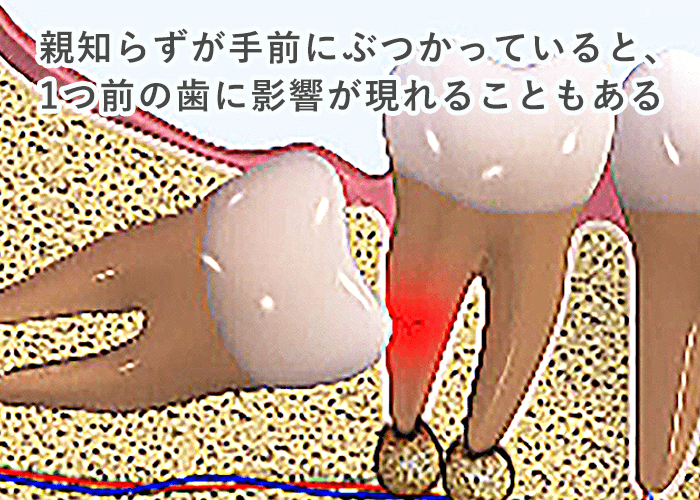 抜歯が最も確実な治療