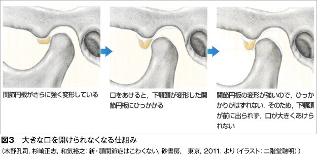 大きな口が開けられなくなる状態