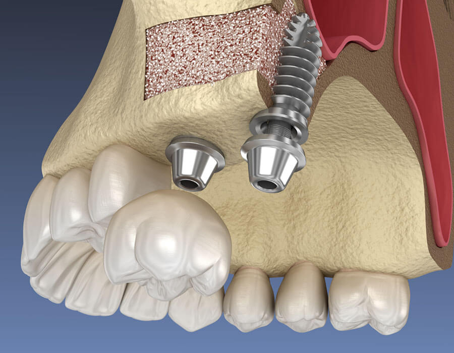 骨造成による再生療法