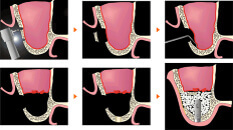 サイナスリフト