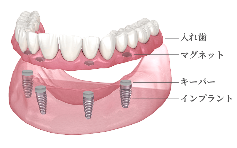 インプラントマグネットデンチャー