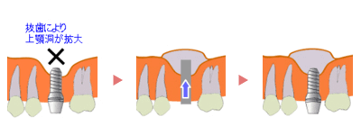 ソケットリフト