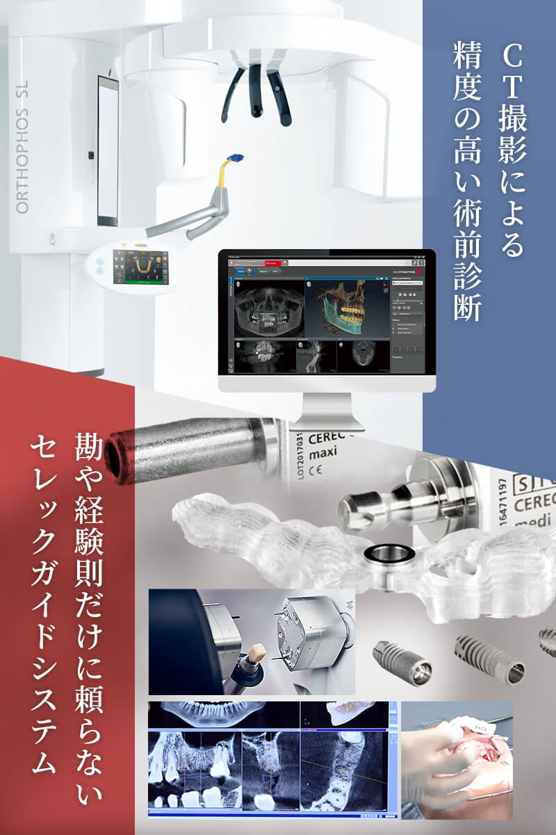 CT・セレックガイド